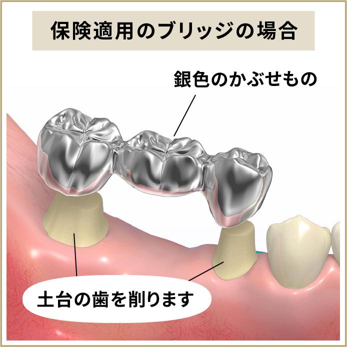 保険適用のブリッジのデメリット