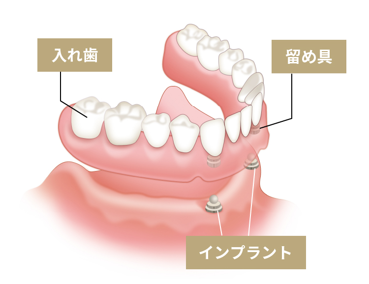 歯がボロボロ・総入れ歯のためのインプラントオーバーデンチャー