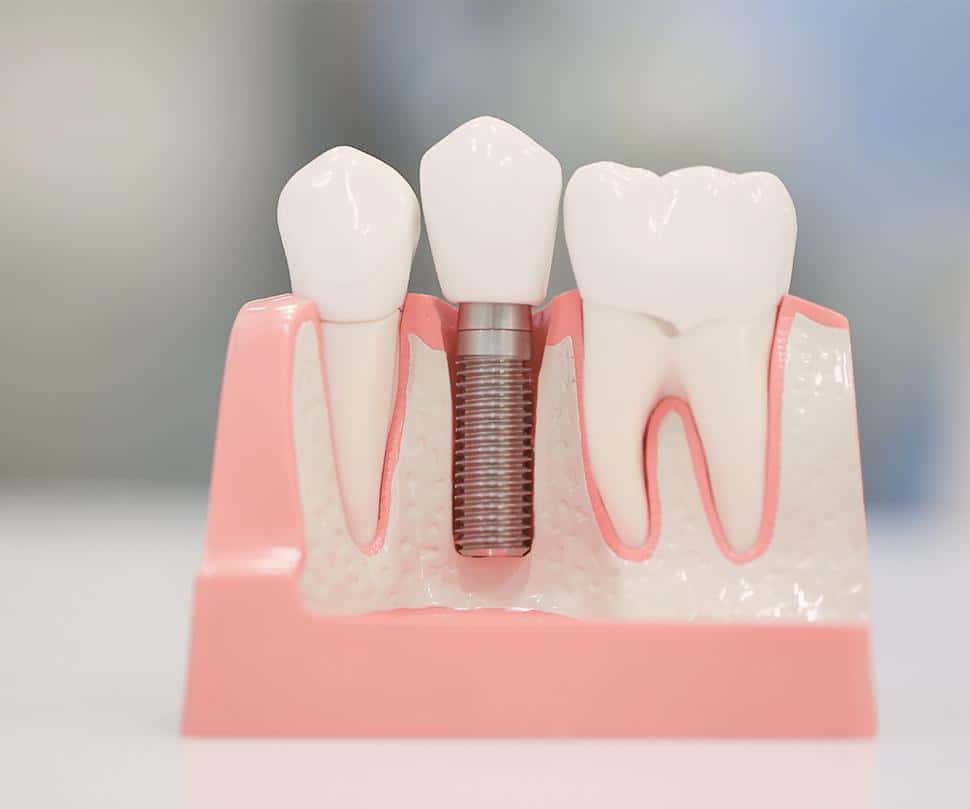 インプラントとは