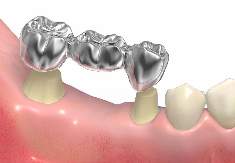 「ブリッジ」の画像検索結果