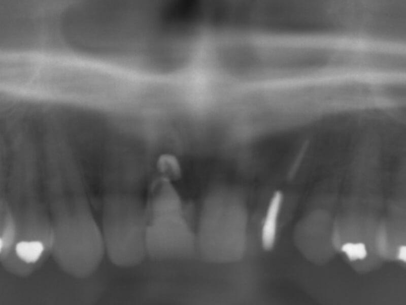 インプラント初診時レントゲン