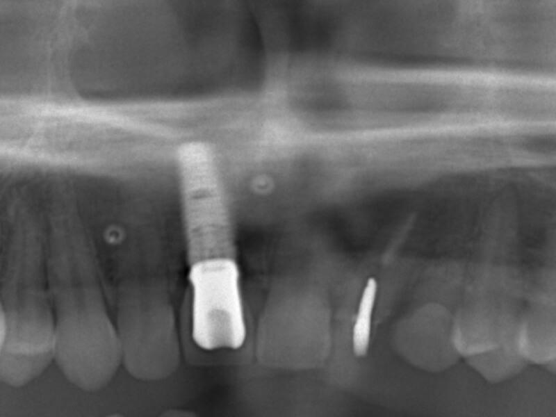 インプラント治療後レントゲン