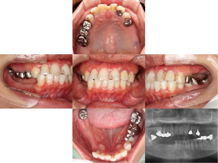 インプラント初診時