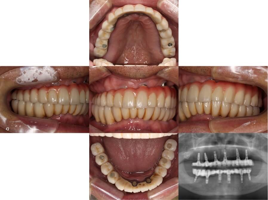 インプラント治療後