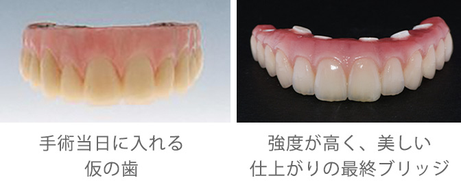 仮の歯と最終ブリッジ