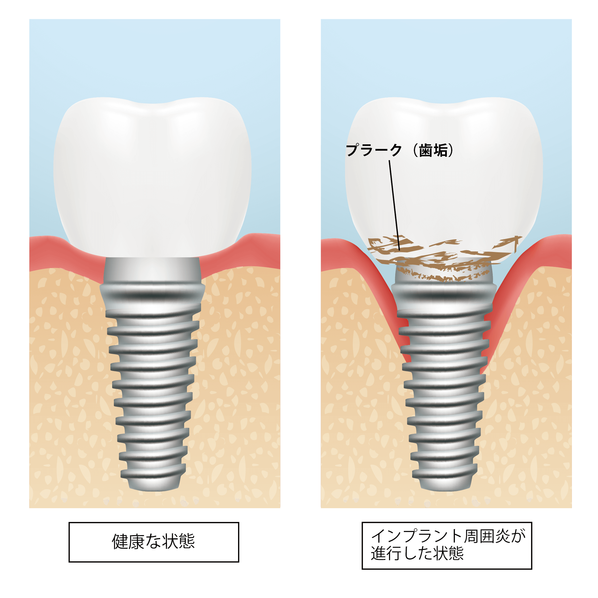 歯ぎしりによるインプラントのリスク