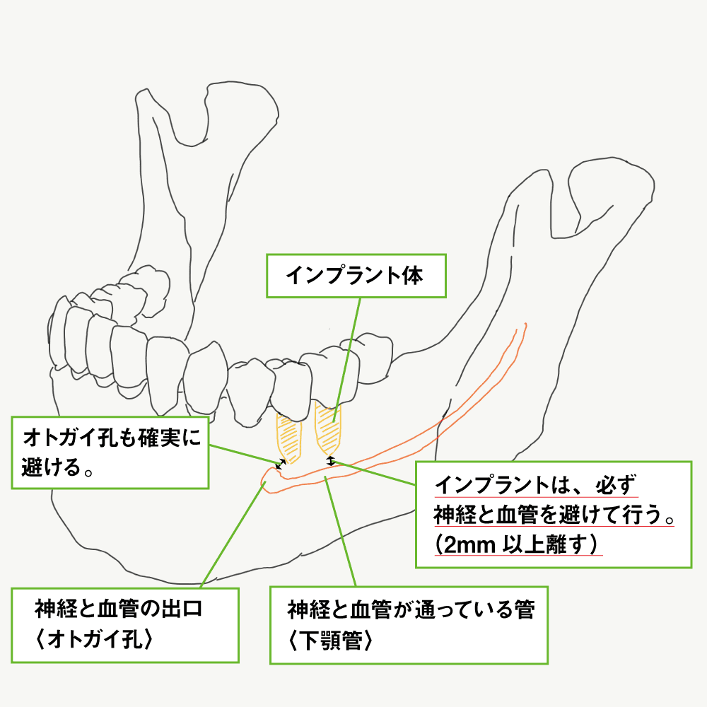 インプラントの解剖学的リスク1