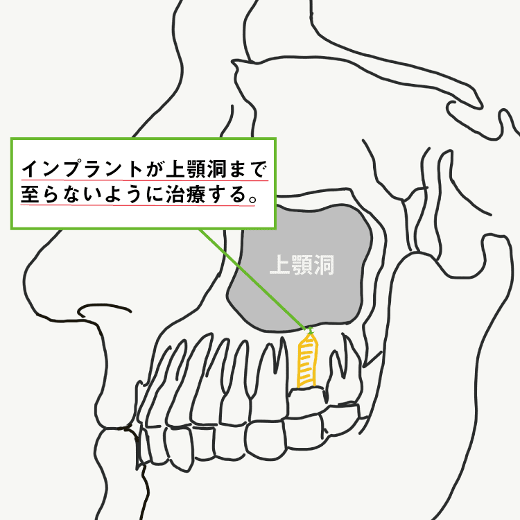 インプラントの解剖学的リスク1