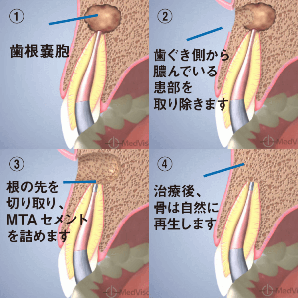 歯を残す歯根端切除術（アピコエクトミー）