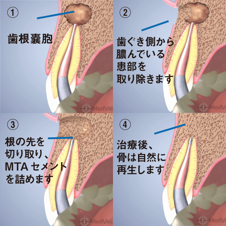 歯根端切除