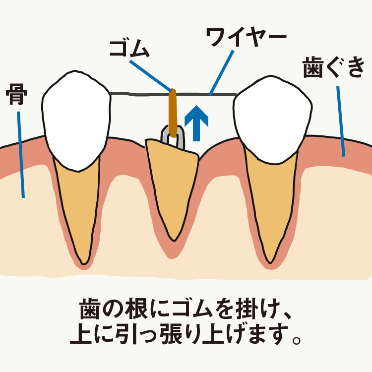 歯根膜による再生治療 歯根膜による再生治療インプラントを考える前に | 下地 勲 |本