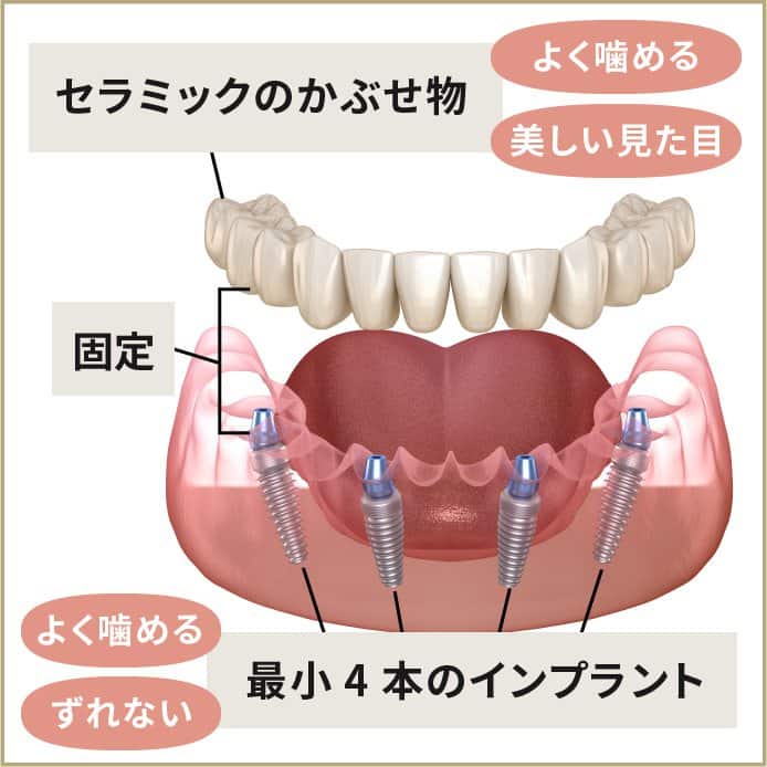 オールオン４ 歯がボロボロ 総入れ歯の方のインプラント 大阪 北浜の筒井歯科のオールオン4