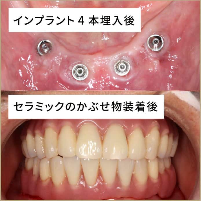 オールオン４ 歯がボロボロ 総入れ歯の方のインプラント 大阪 北浜の筒井歯科のオールオン4