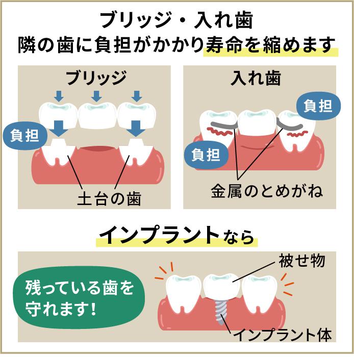 インプラントのメリット