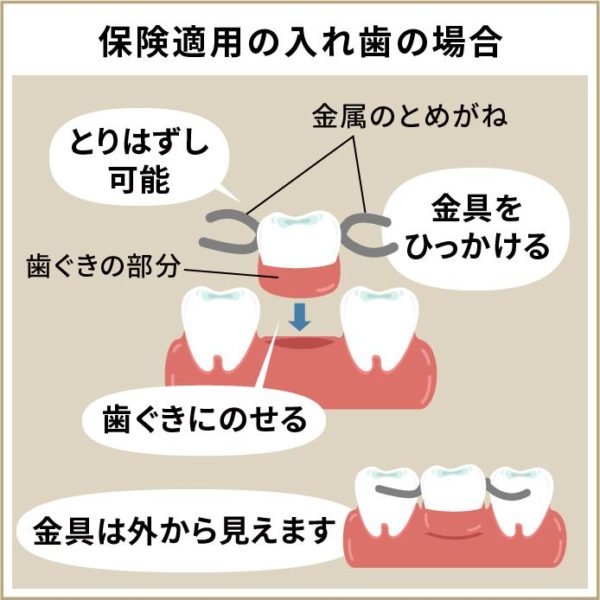 入れ歯について