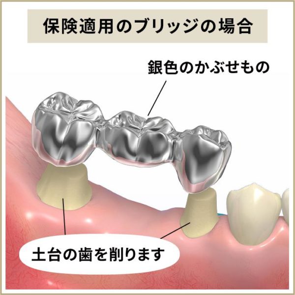 ブリッジについて