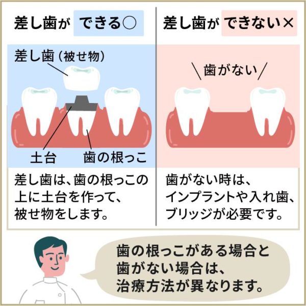 差し歯とインプラントとの違い