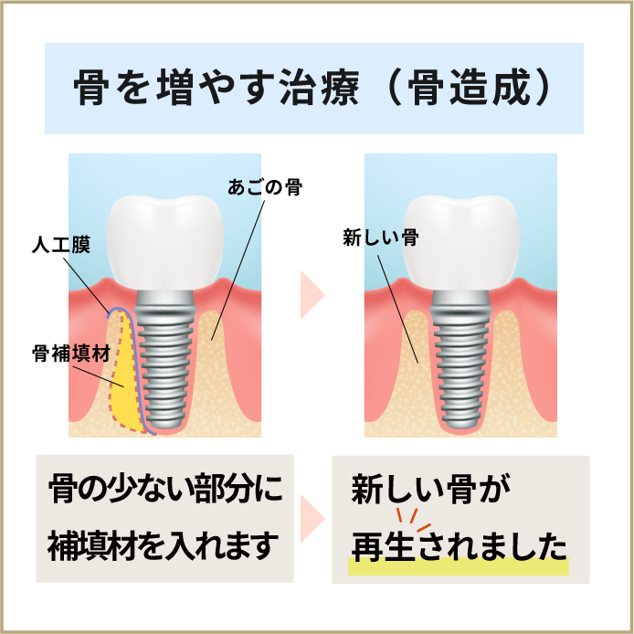 骨の造成