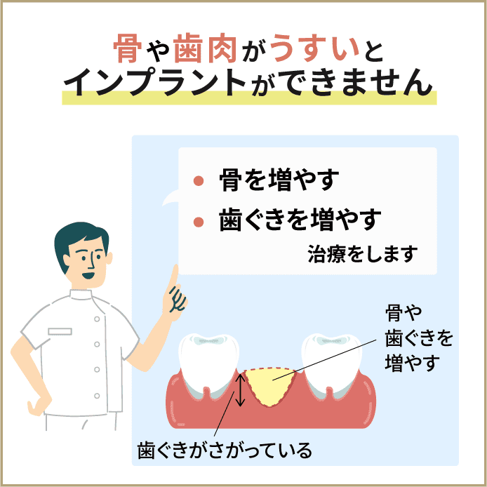 インプラントのリスクとして歯ぐきが下がることがあります