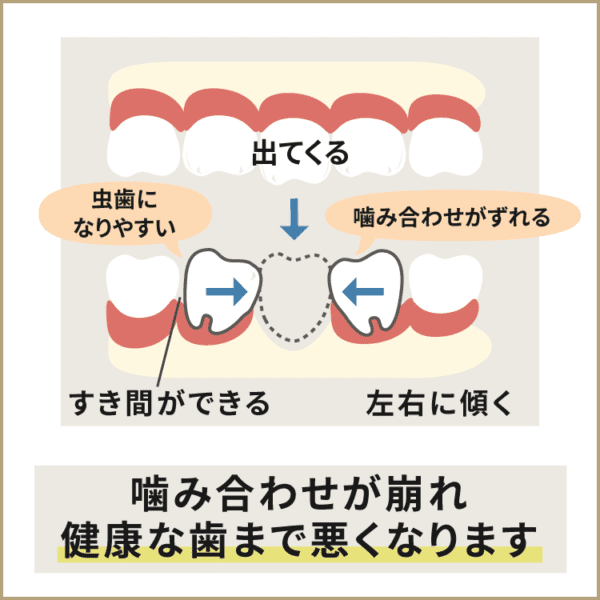 歯が抜けたまま放っておくと