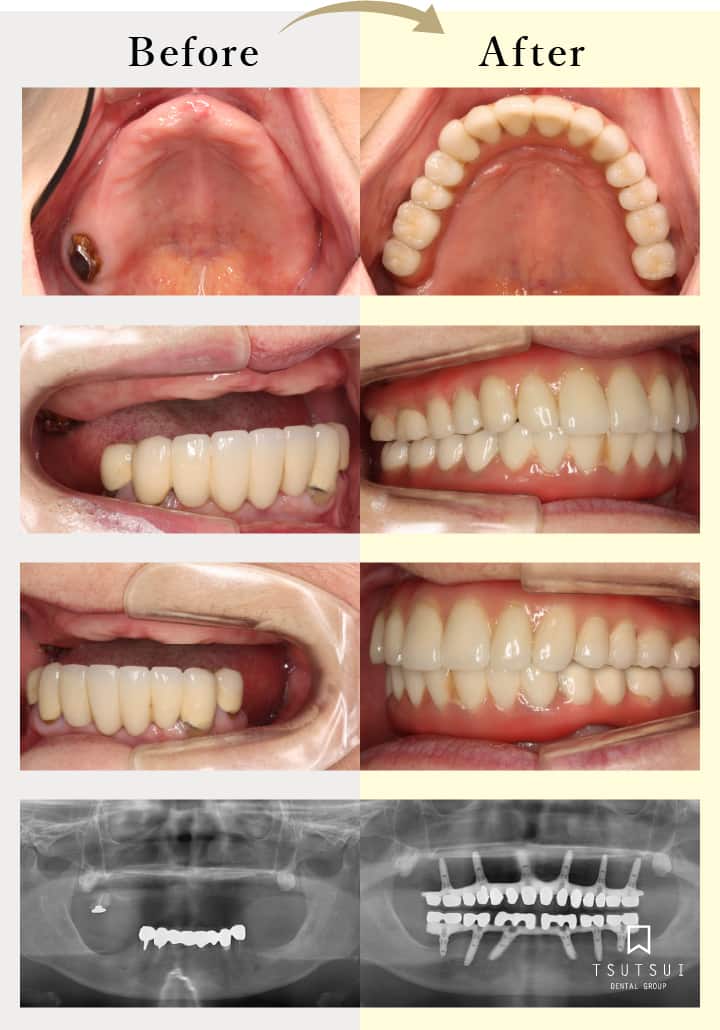 オールオン４はどんな治療 動画でも解説 インプラントなら大阪 関西の筒井歯科