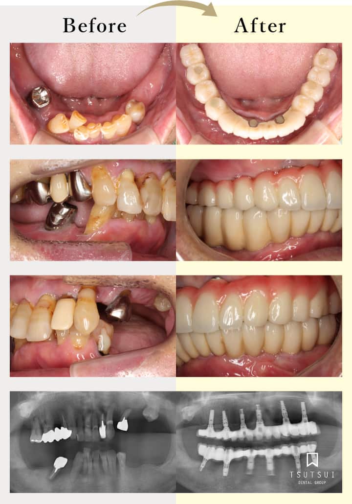 オールオン４ 歯がボロボロ 総入れ歯の方のインプラント 大阪 北浜の筒井歯科のオールオン4