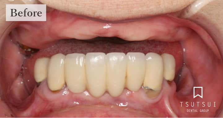 オールオンフォー症例ビフォア60代女性