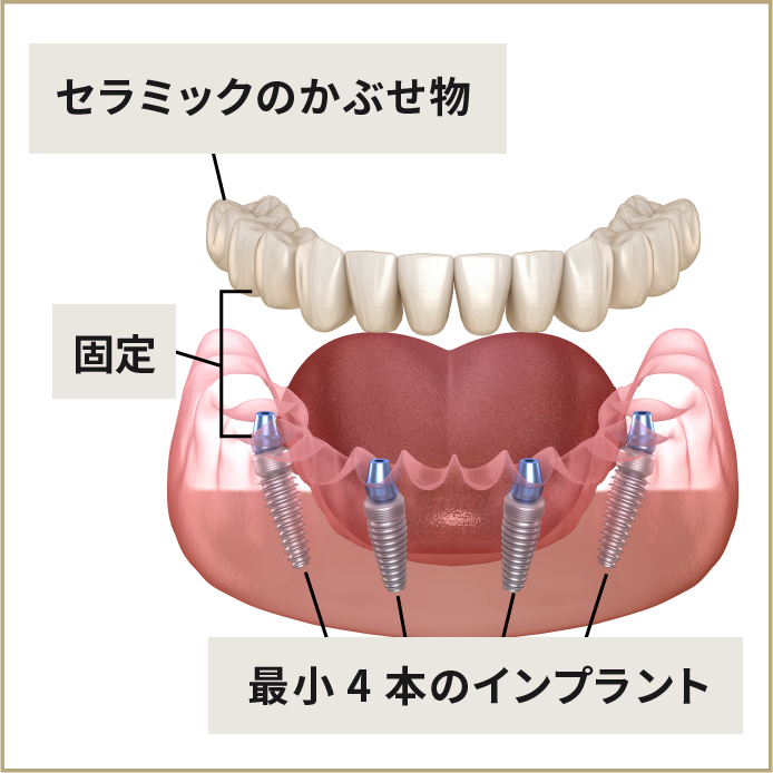 オールオン4(オールオンフォー)の全体像