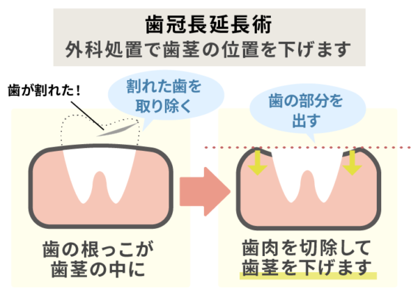 歯冠長延長術