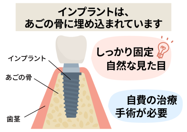 インプラントはあごの骨に埋入