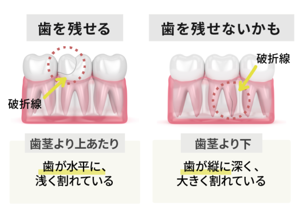 根っこが割れた時の治療方法