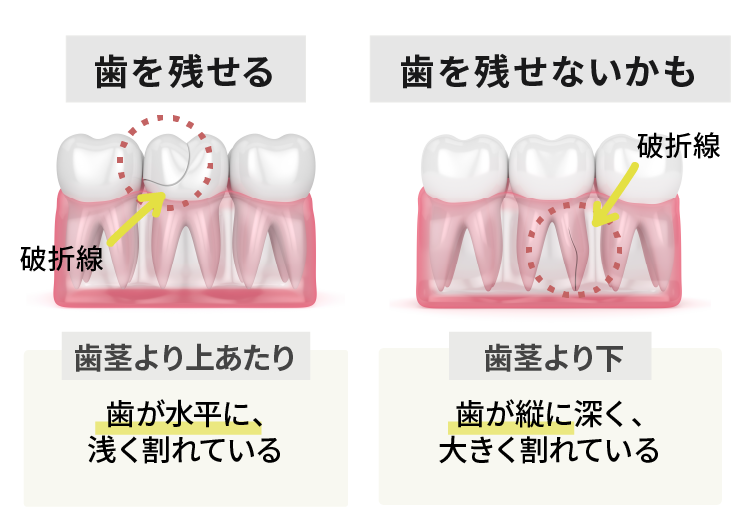 歯根破折　歯を残せる場合、残せない場合