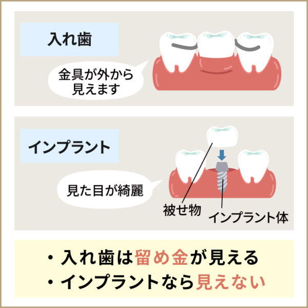 インプラントは見た目がきれい