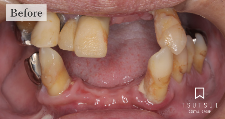 オールオン４ 歯がボロボロ 総入れ歯の方のインプラント 大阪 北浜の筒井歯科のオールオン4