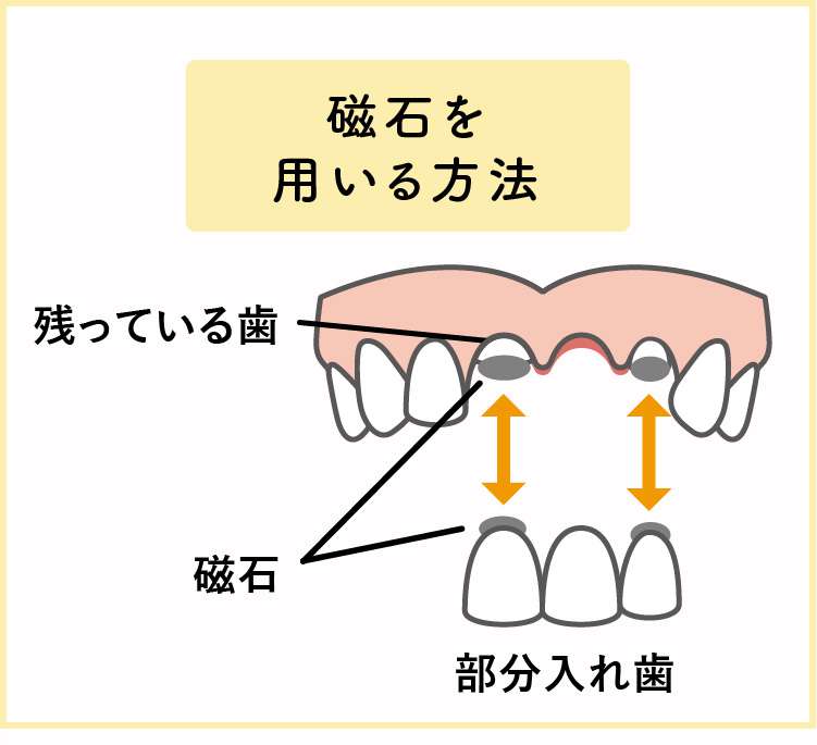 自分の歯が残っている場合