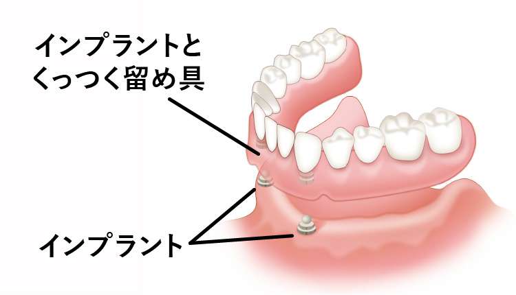 歯がなくインプラントで固定する場合