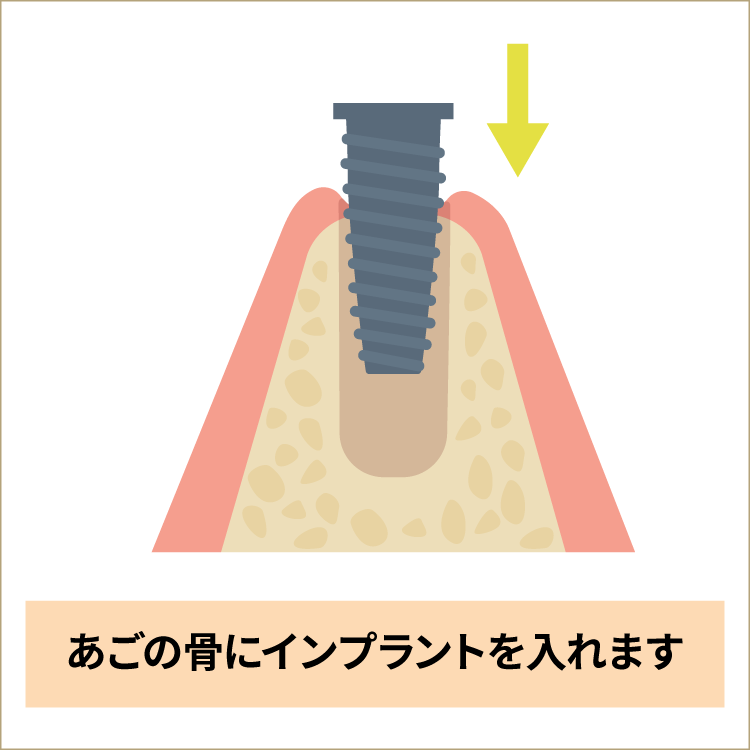 インプラントを埋入します