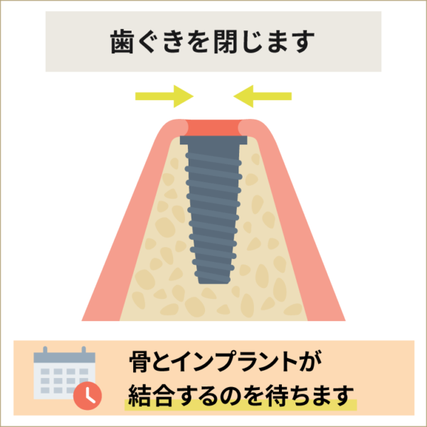 インプラント埋入後