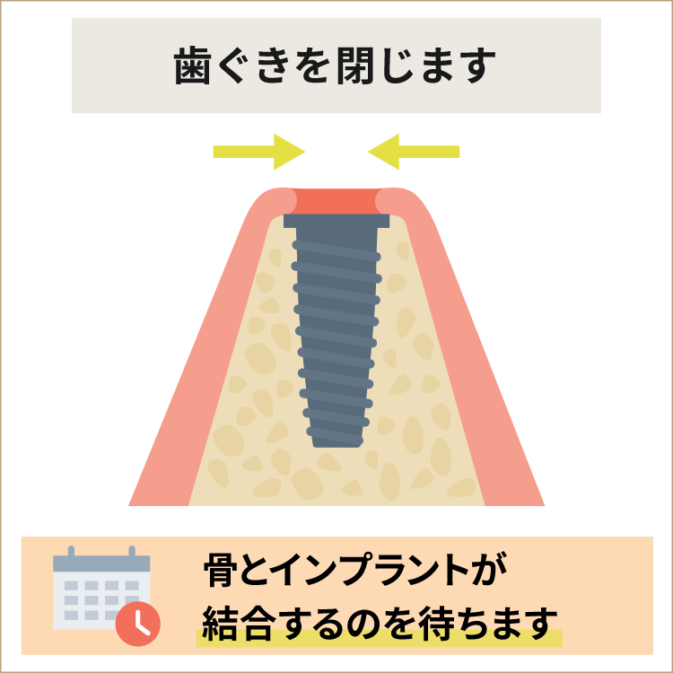 歯ぐきを閉じます