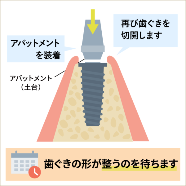 インプラントの手術