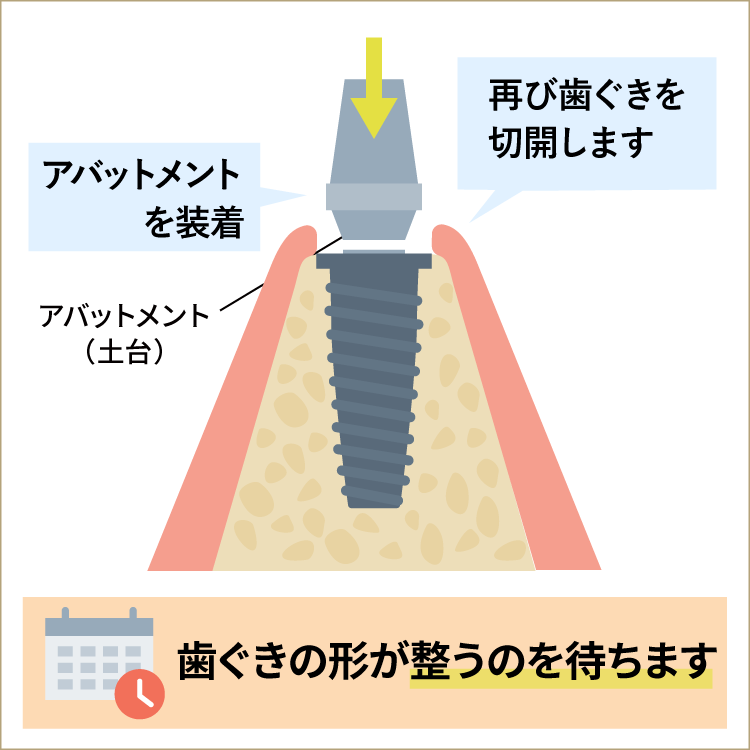 インプラントを埋入します