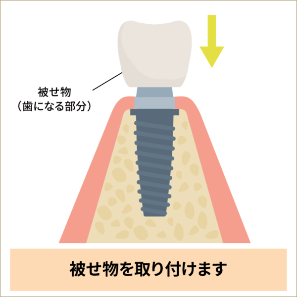 インプラント手術ー被せ物装着