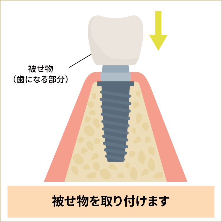 被せ物を装着