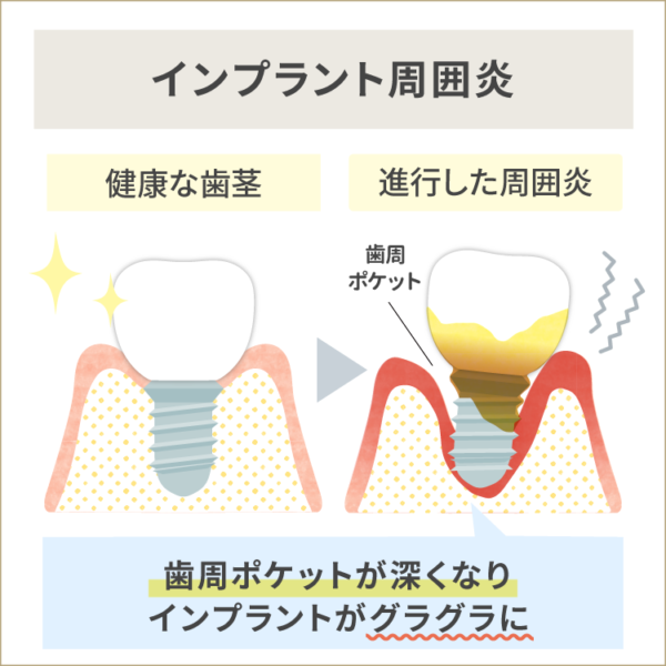 インプラント周囲炎について