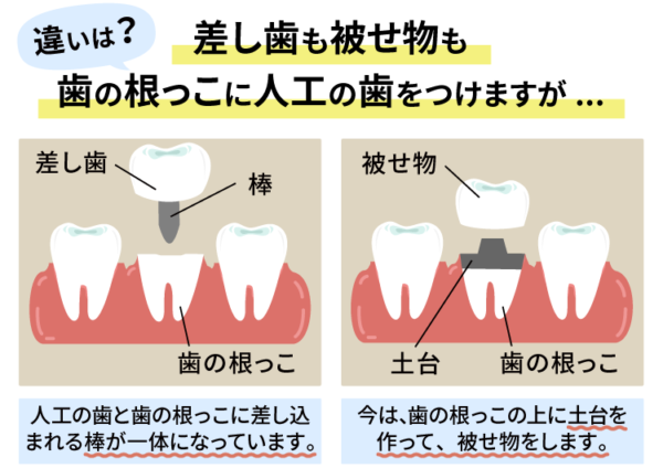 差し歯と被せ物の違い