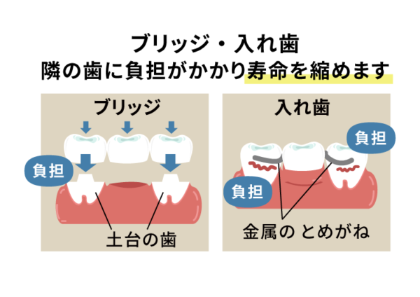 ブリッジ、入れ歯の隣の歯に負担がかかります