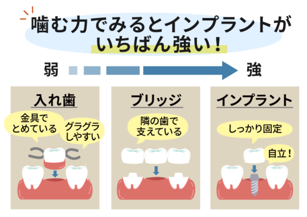 噛む力はインプラントが一番強い