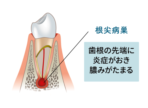 根尖病巣