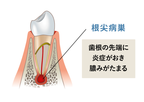 歯の根に膿がたまる