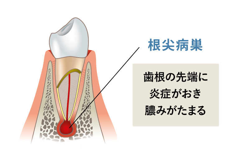 根尖病巣